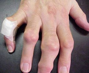 Finger mit Gelenkdeformitäten verursachen Schmerzen