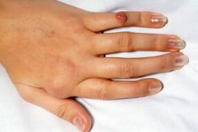 Schmerzen in deformierten Fingern