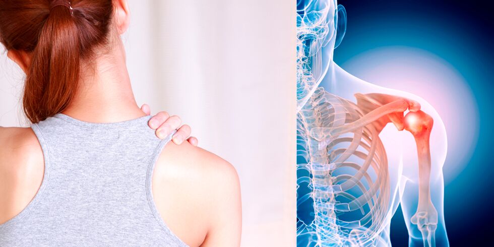 Die Entwicklung einer Arthrose der Schulter führt allmählich zu ständigen Schmerzen