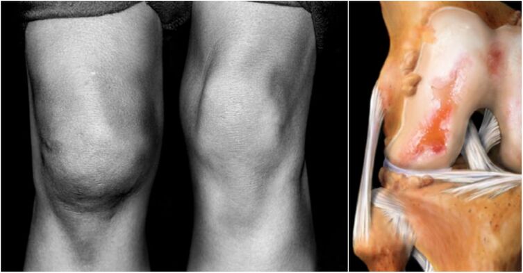 Arthrose des Kniegelenks und des Schmerzensgelenks