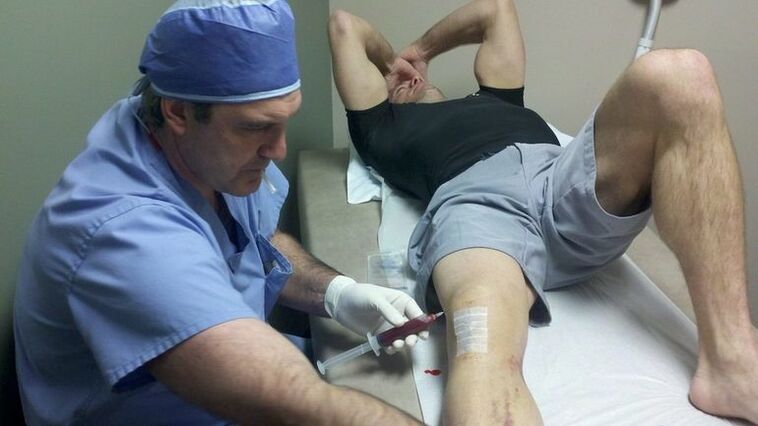 Behandlung der Arthrose des Kniegelenks