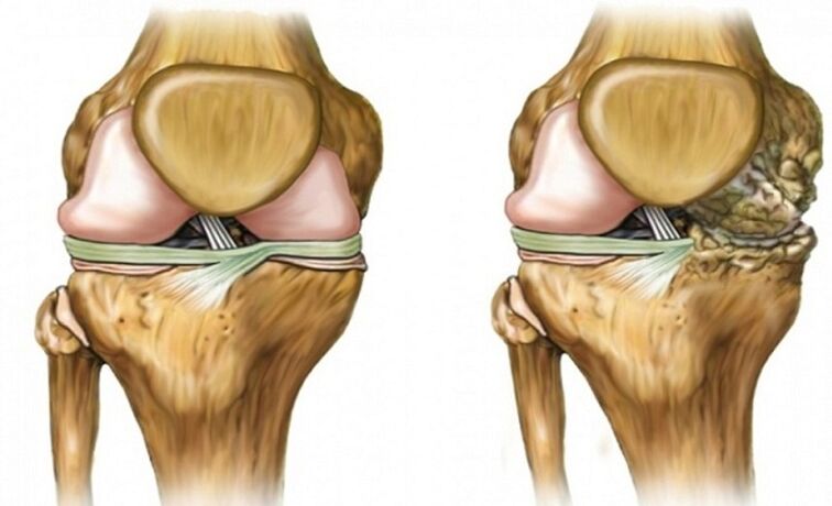 Gesund und durch das Arthrosis -Gelenk betroffen