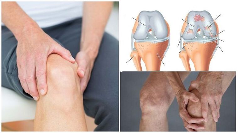 Knieschmerzen Symptom für Arthrose des Kniegelenks