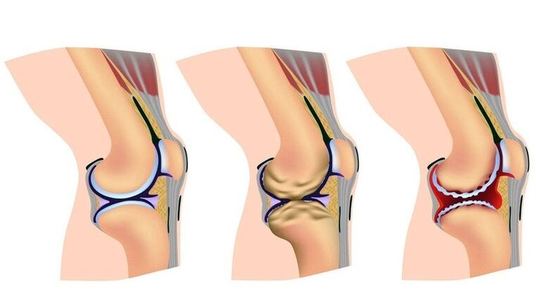 Verformungsstadien im Kniegelenk zur Arthrose