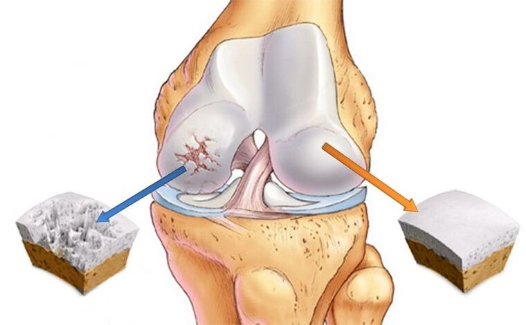 normaler Knorpel und durch Arthrose betroffen