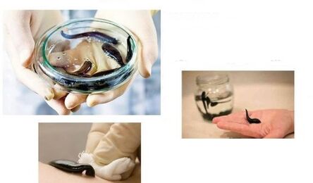 Hirudotherapie bei Arthrose